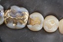 Scott Kanamori #29 amalgam removal