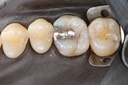 Scott Kanamori #3 pre-op with dam