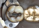 Scott Kanamori #31 amalgam removal