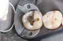 Scott Kanamori #31 amalgam removal