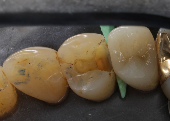 Scott Kanamori #5 amalgam removal
