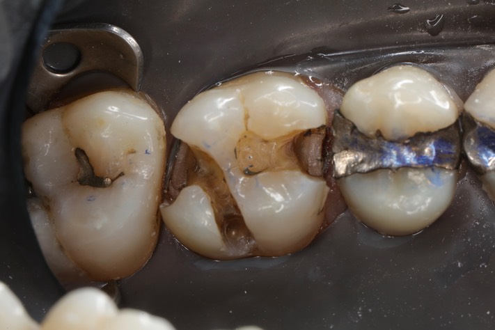 Ted Kanamori #14 amalgam removal