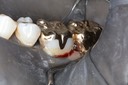 Ted Kanamori #18-19 finish buccal view