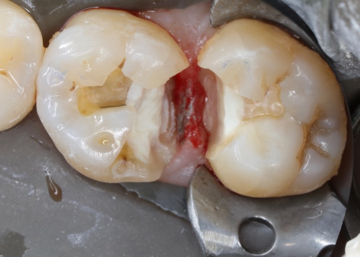 Ted Kanamori #2-3 composite removal