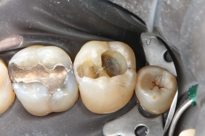 Ted Kanamori #2 caries removal