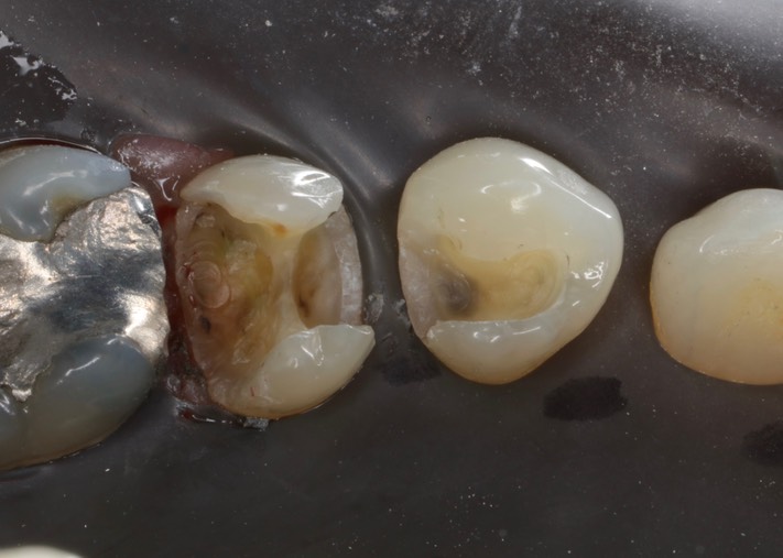 Ted Kanamori #28-29 amalgam removal