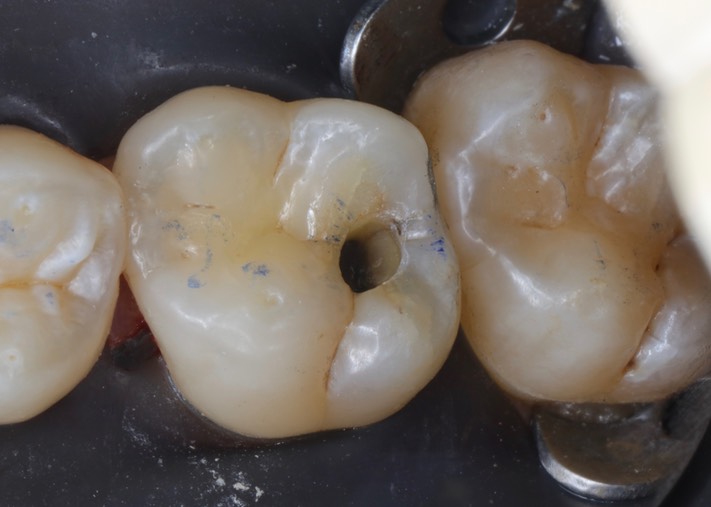 Ted Kanamori #3 amalgam removal