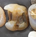 Ted Kanamori #3 crown removal 