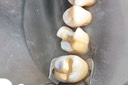 Ted Kanamori #3 prep - buccal