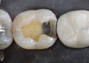Ted Kanamori #31 caries removal