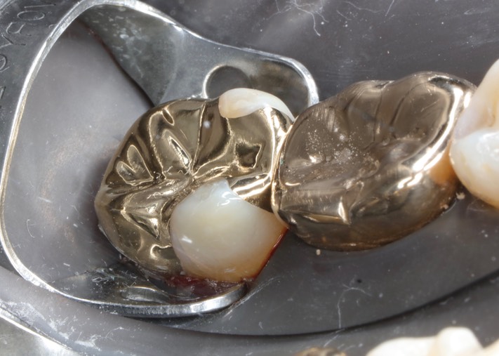 Ted Kanamori #31 finish buccal view