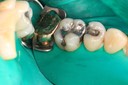 Ted Kanamori #13-14 pre-op lingual view
