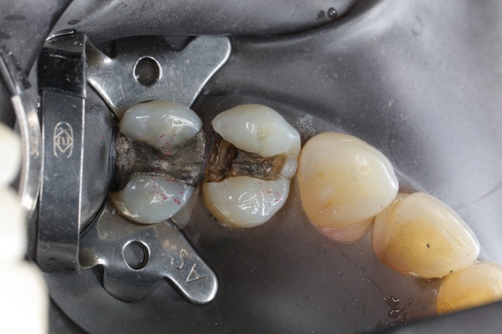 Wes Sato #12 amalgam removal