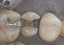 Wes Sato #13 amalgam removal