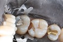 Wes Sato #14 amalgam removal