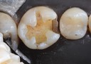 Wes Sato #30 caries removal