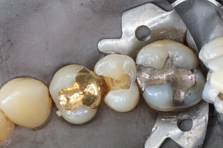 Wes Sato #4 amalgam removal
