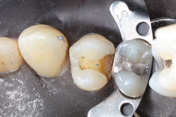 Wes Sato #5 caries removal